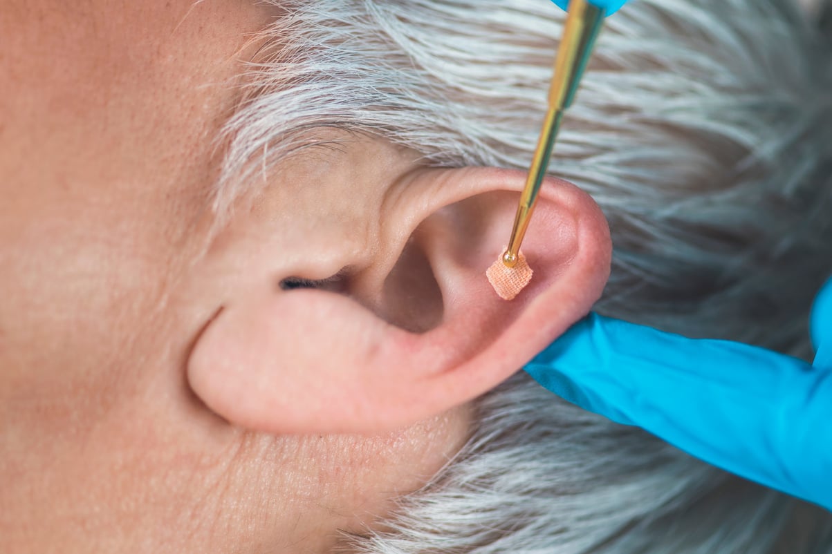 Auricular Therapy